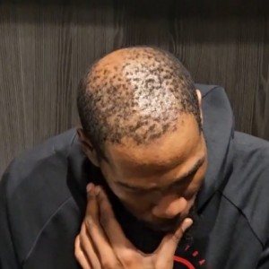 开云体育-37岁还单身有原因😳！杜兰特秃顶这么严重 这发量找对象难啊